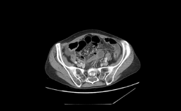 Quiz: CT-beelden abdomen