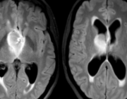 MRI van de hersenen bij de acute, intern ontregelde patiënt