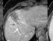 Ondersteunende MRIbevindingen bij de LI-RADS-classificatie van leverlaesies