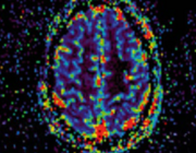 Cerebrale radiatienecrose bij hersenmetastasen en primaire hersentumoren