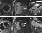 Beeldvorming van myocarditis middels cardiale MRI