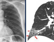 CT-thorax bij COVID-19