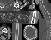 Standaardisering scanprotocol en verslaglegging van wholebody low-dose CT bij patiënten met multipel myeloom