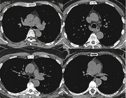 Normaal aspect van de thymus bij volwassenen op CT-scan