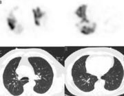 Perfusie-SPECT/CT voor longemboliediagnostiek bij COVID-19geassocieerde ziekte