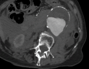 Beeldvormende diagnostiek en radiologische interventies bij het abdominaal aorta-aneurysma