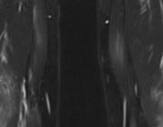 Perivasculair oedeem op de MRI bij polyarteriitis nodosa