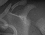Röntgenfoto bij verdenking op neonatale claviculafractuur