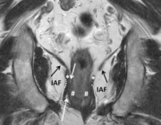 Radiologische beeldvorming van het anuscarcinoom