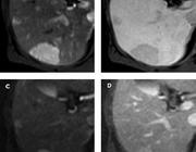 MRI van focale, solide leverlaesies in de niet-cirrotische lever